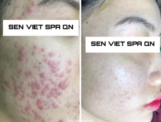 Sen Việt Spa - Ảnh: sưu tầm
